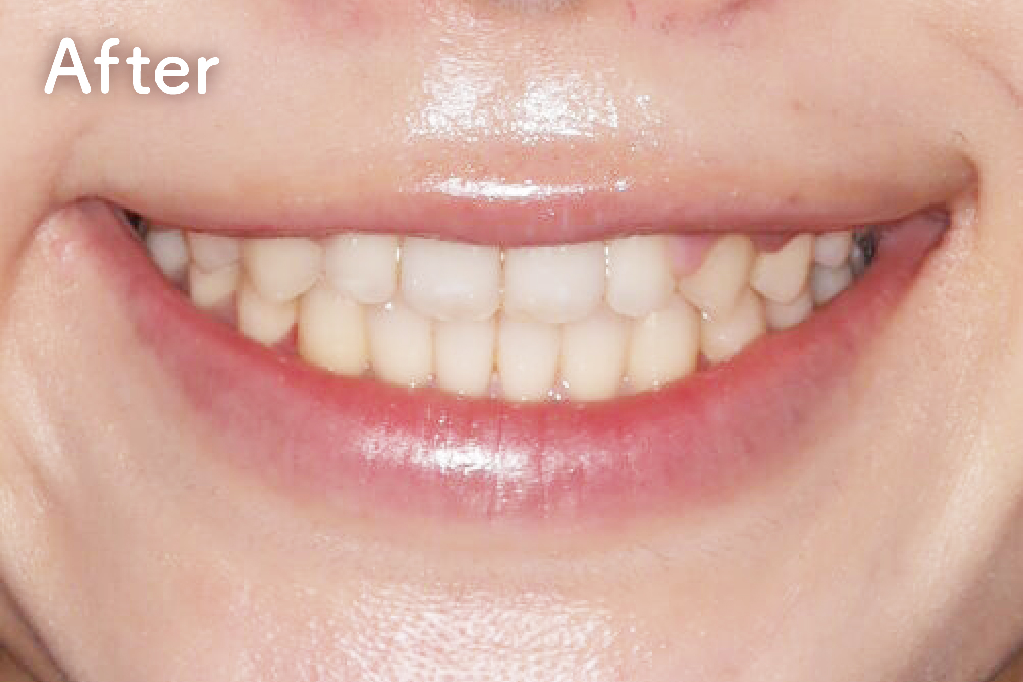 新井矯正歯科・八王子・立川・国分寺